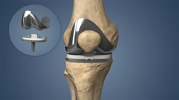 Is Knee Replacement the Only Option for Arthritis